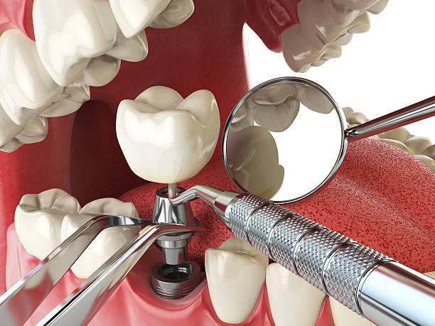 Best Broken or Chipped Tooth Repair in Schererville, IN